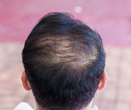 12 Proven Home Remedies to Prevent Hair Loss and Regrow Your Hair Naturally